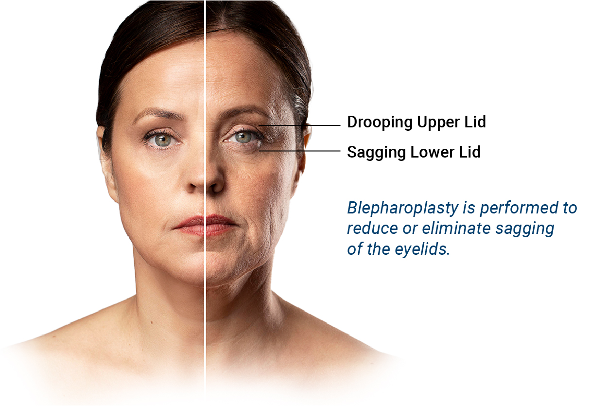 BLEPHAROPLASTY-qht