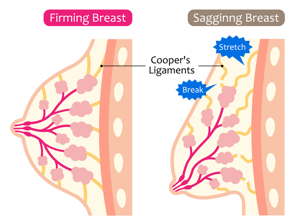 breast-lift-ght