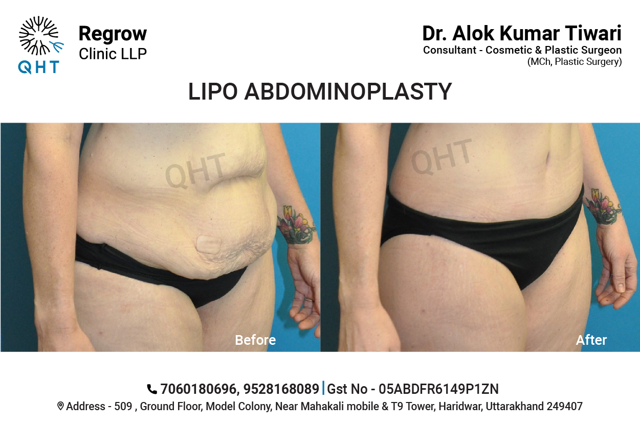 Abdominoplasty-QHT