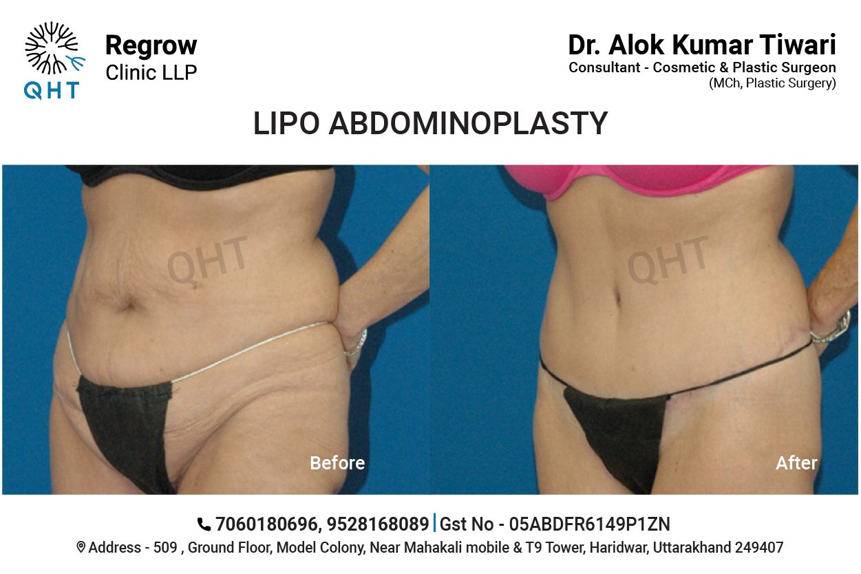 Abdominoplasty-QHT