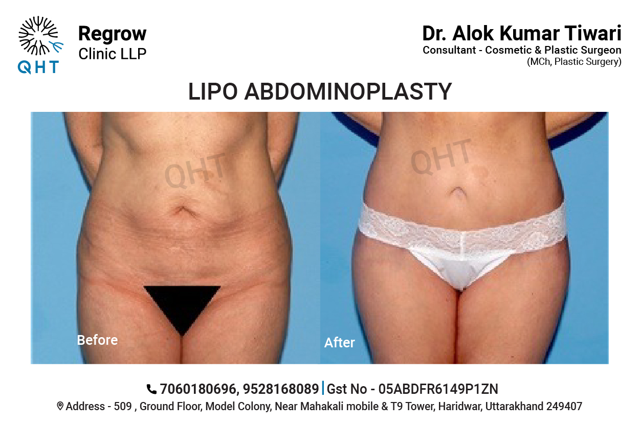 Abdominoplasty-QHT