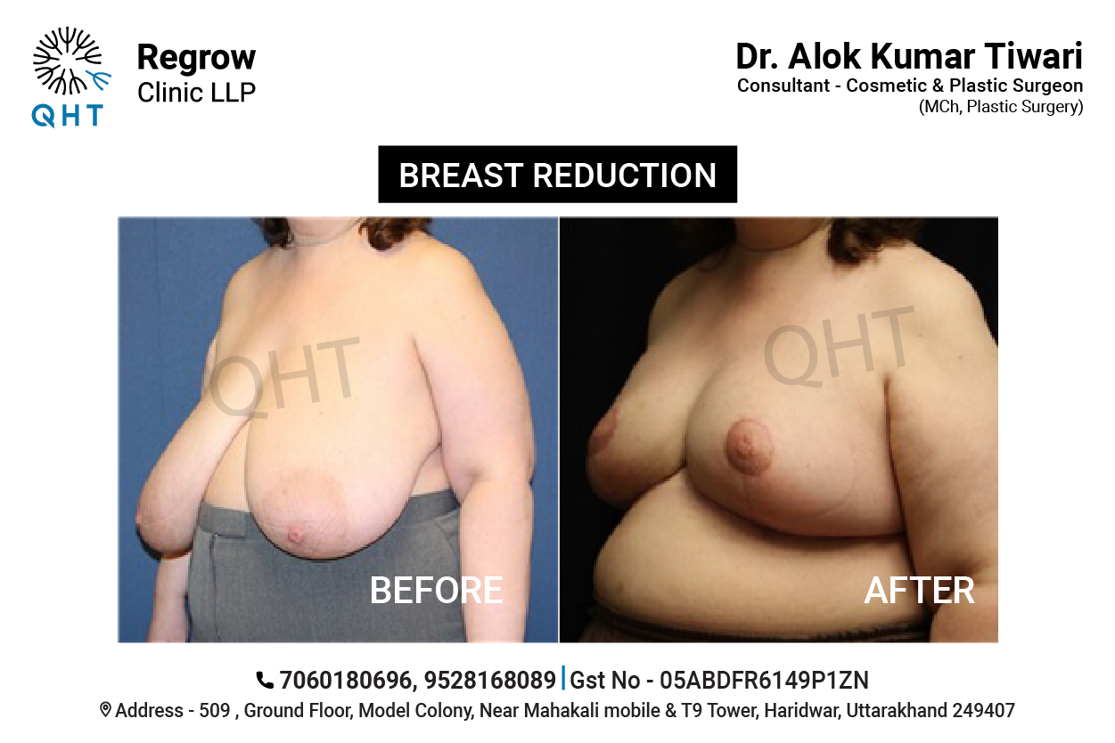 breast-reduction-qht