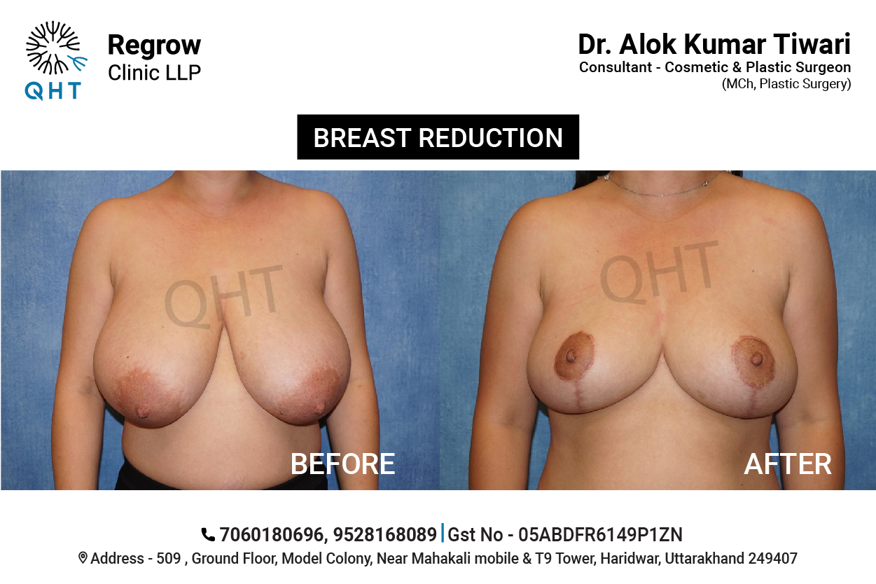 breast-reduction-qht