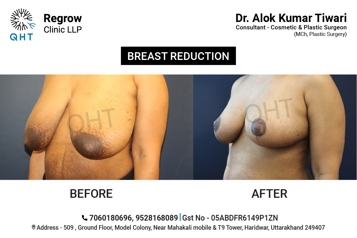 breast-reduction-qht