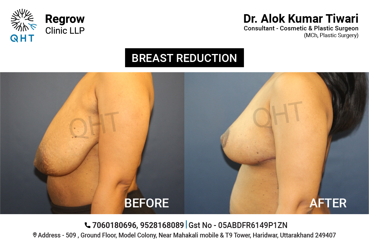 breast-reduction-qht