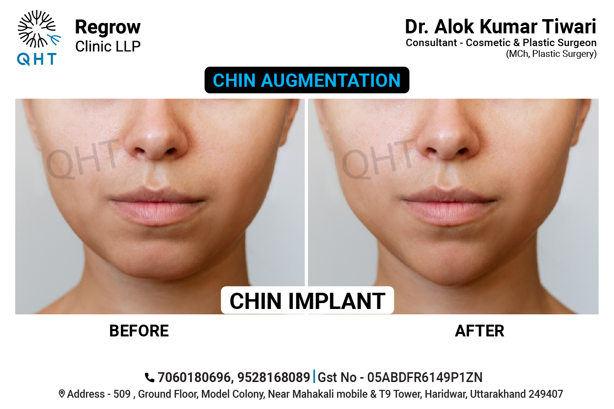 CHIN-IMPLANT-QHT