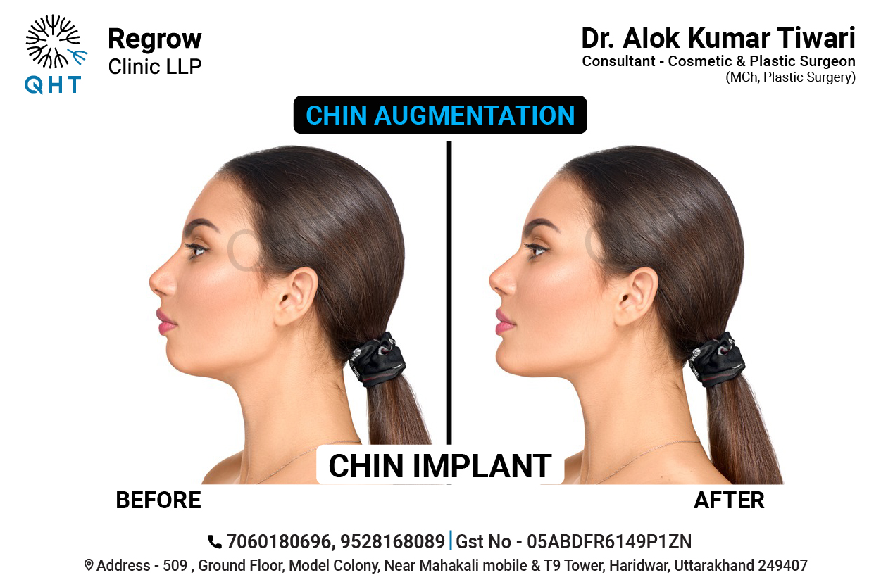 CHIN-IMPLANT-QHT