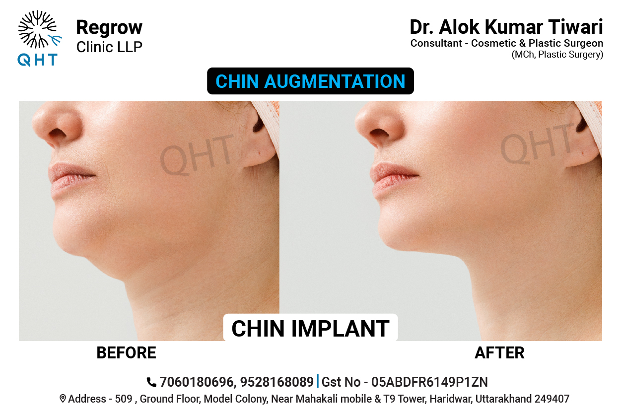 CHIN-IMPLANT-QHT