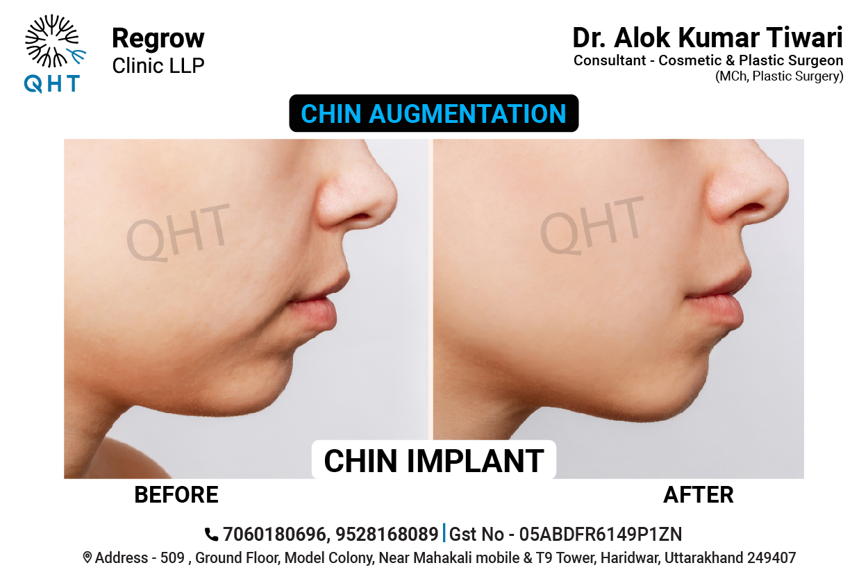 CHIN-IMPLANT-QHT