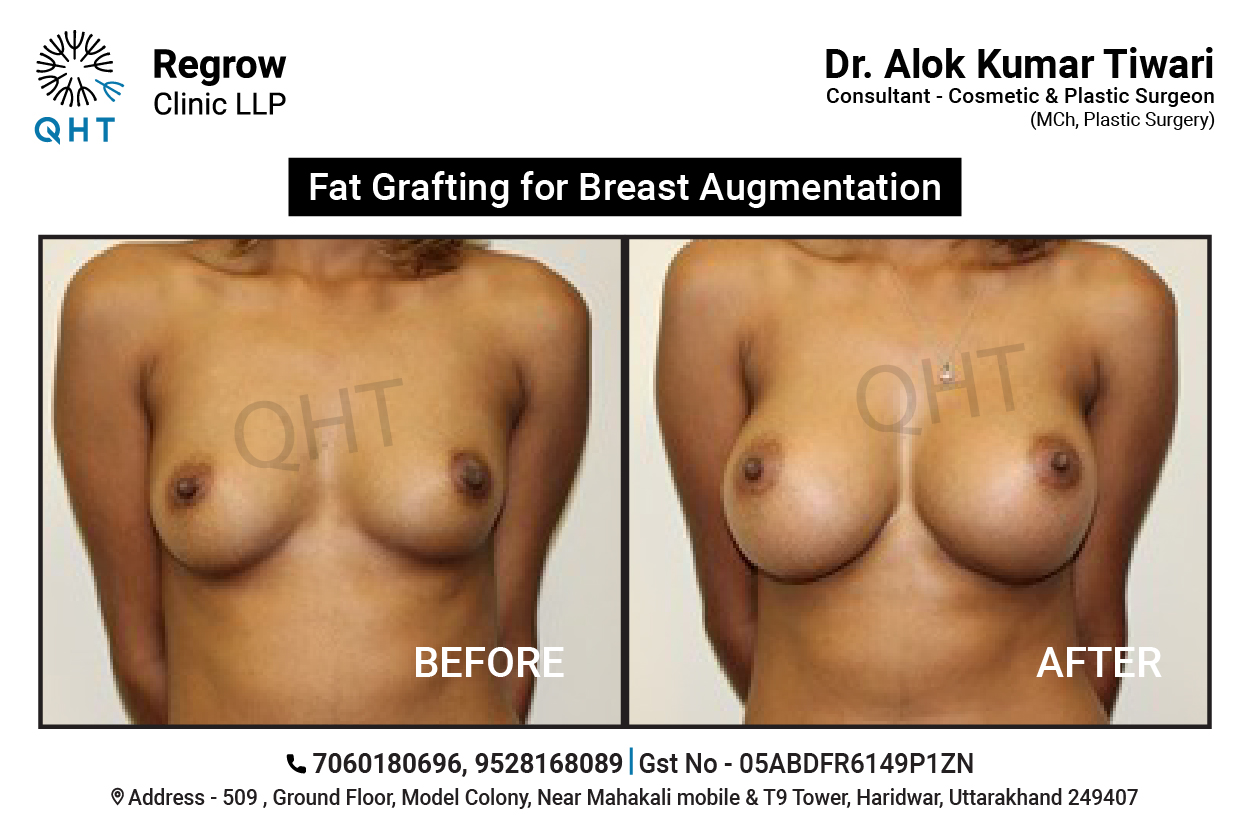 fat-transfer-to-breast-qht