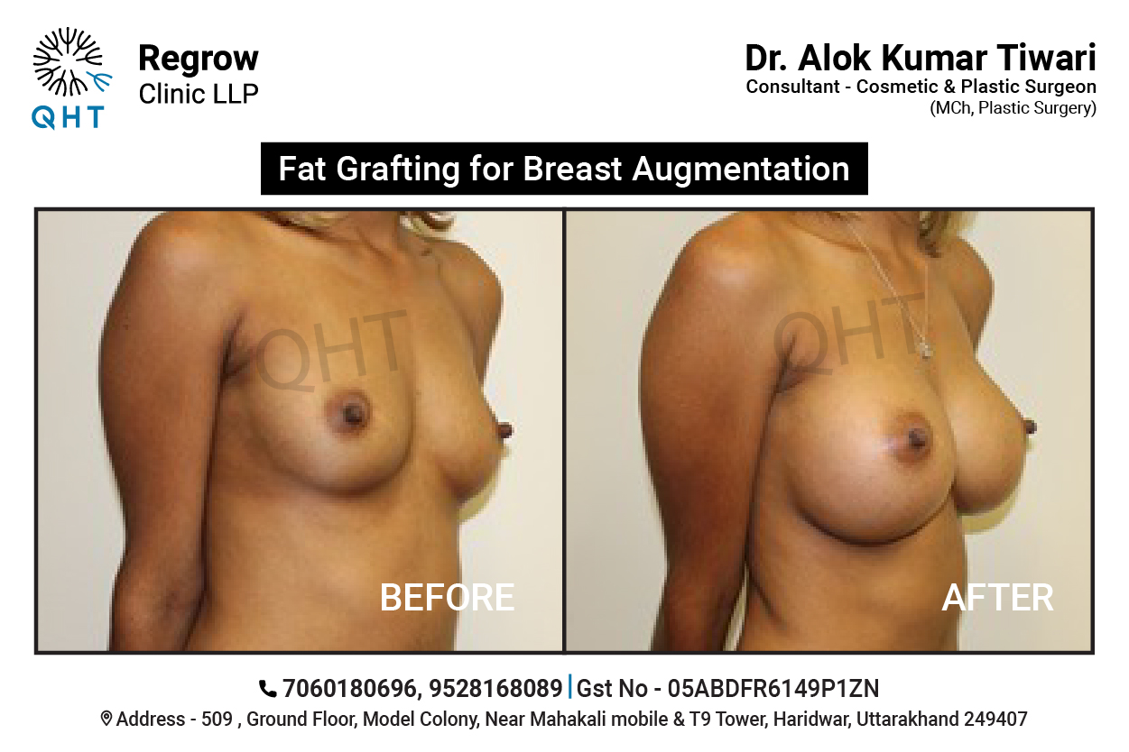 fat-transfer-to-breast-qht