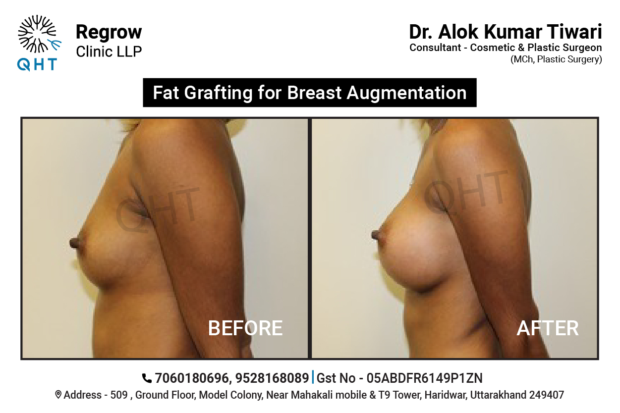 fat-transfer-to-breast-qht