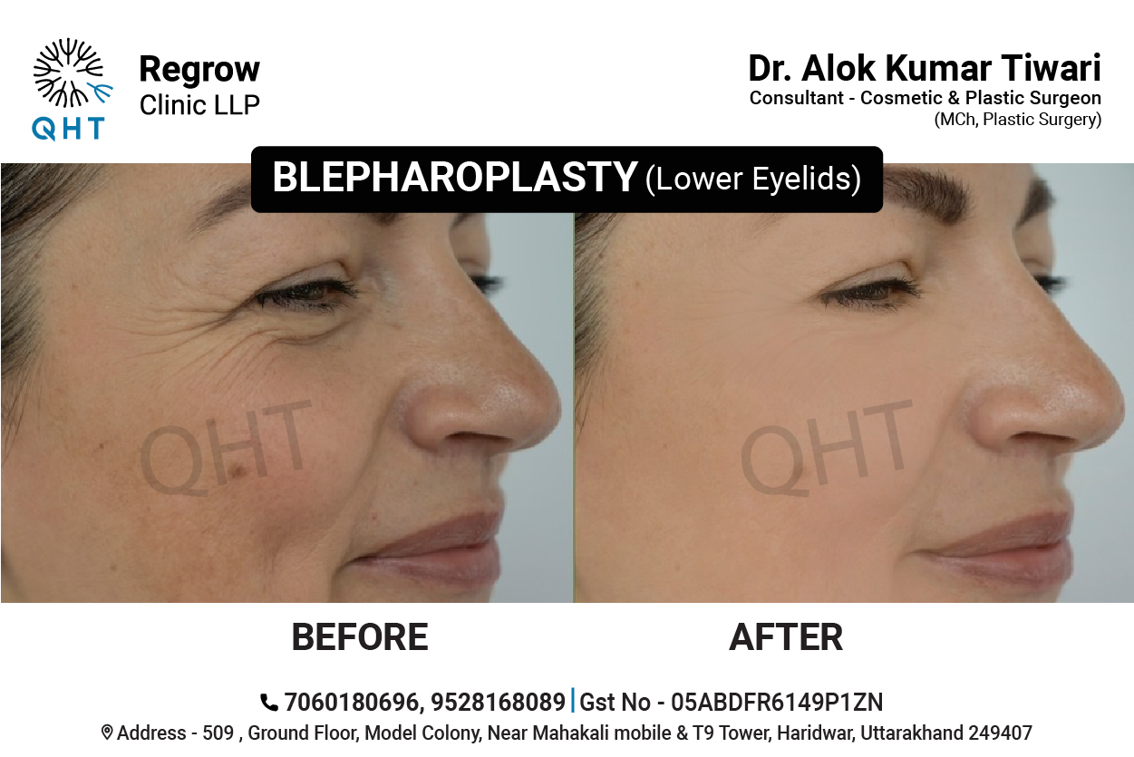 blepharoplasty-qht