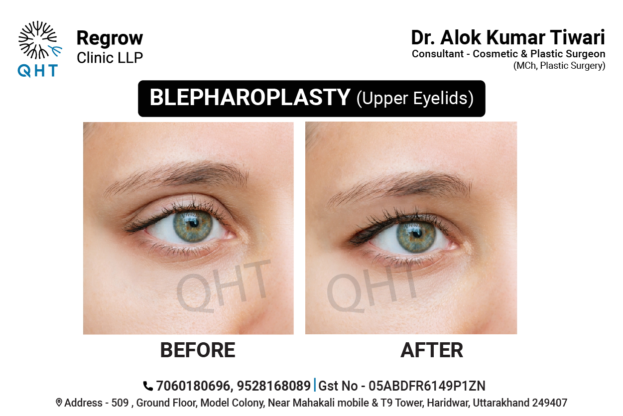 blepharoplasty-qht