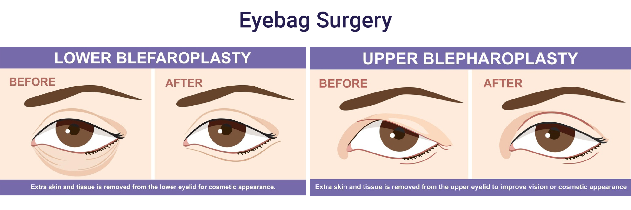 eyebag-surgery-qht