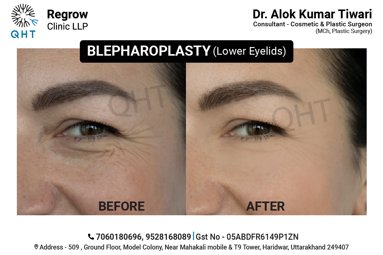 blepharoplasty-qht