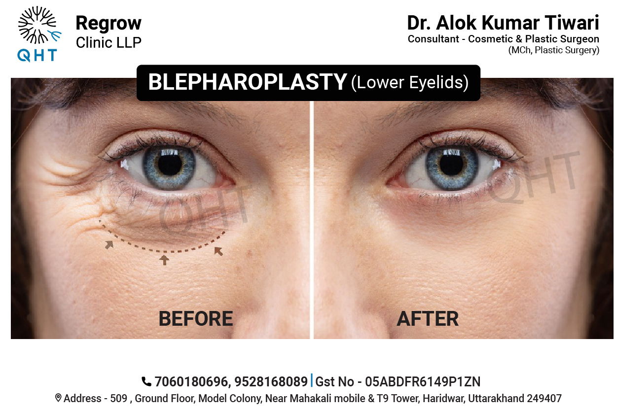 blepharoplasty-qht