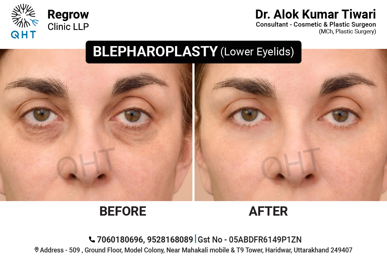 blepharoplasty-qht