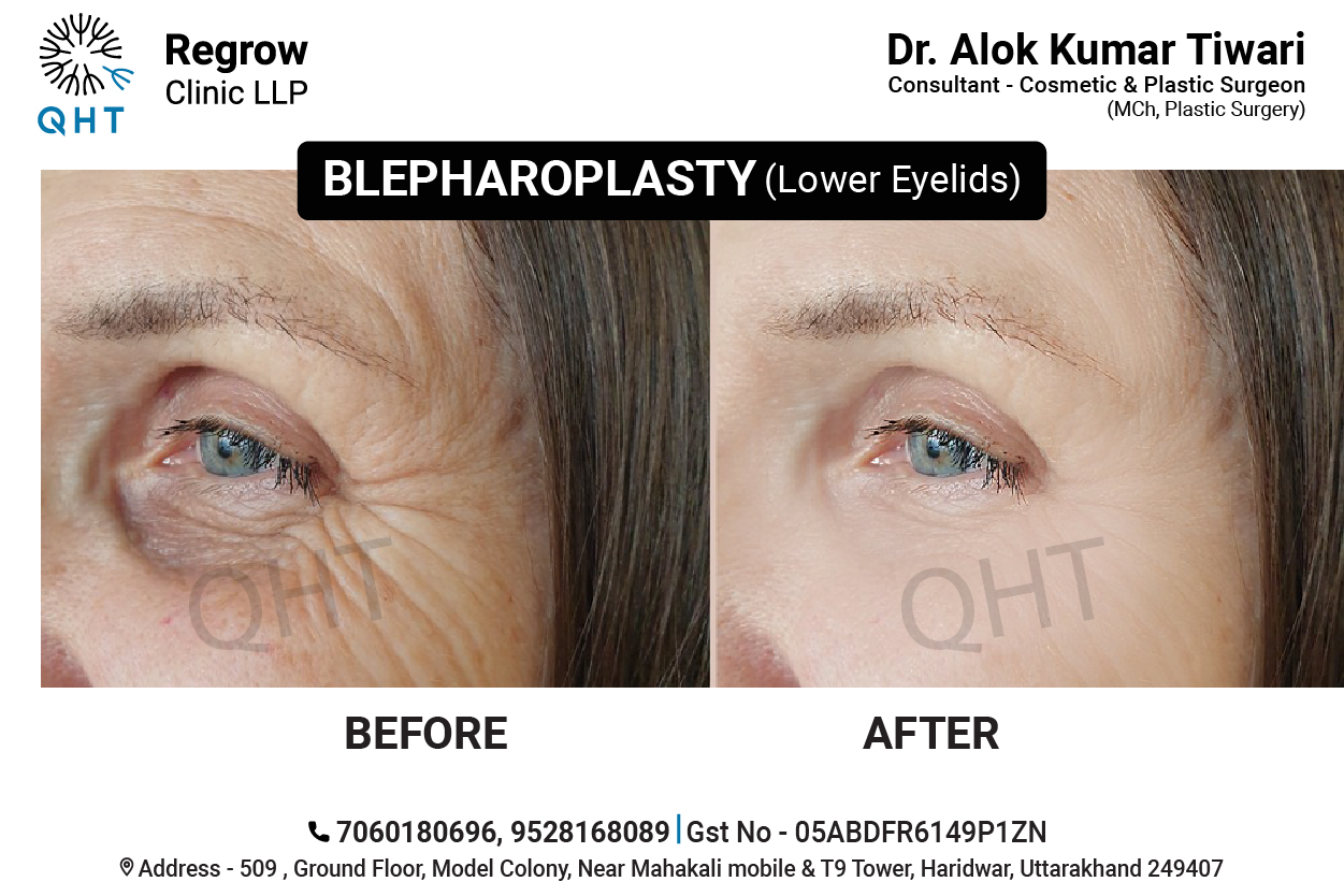 blepharoplasty-qht