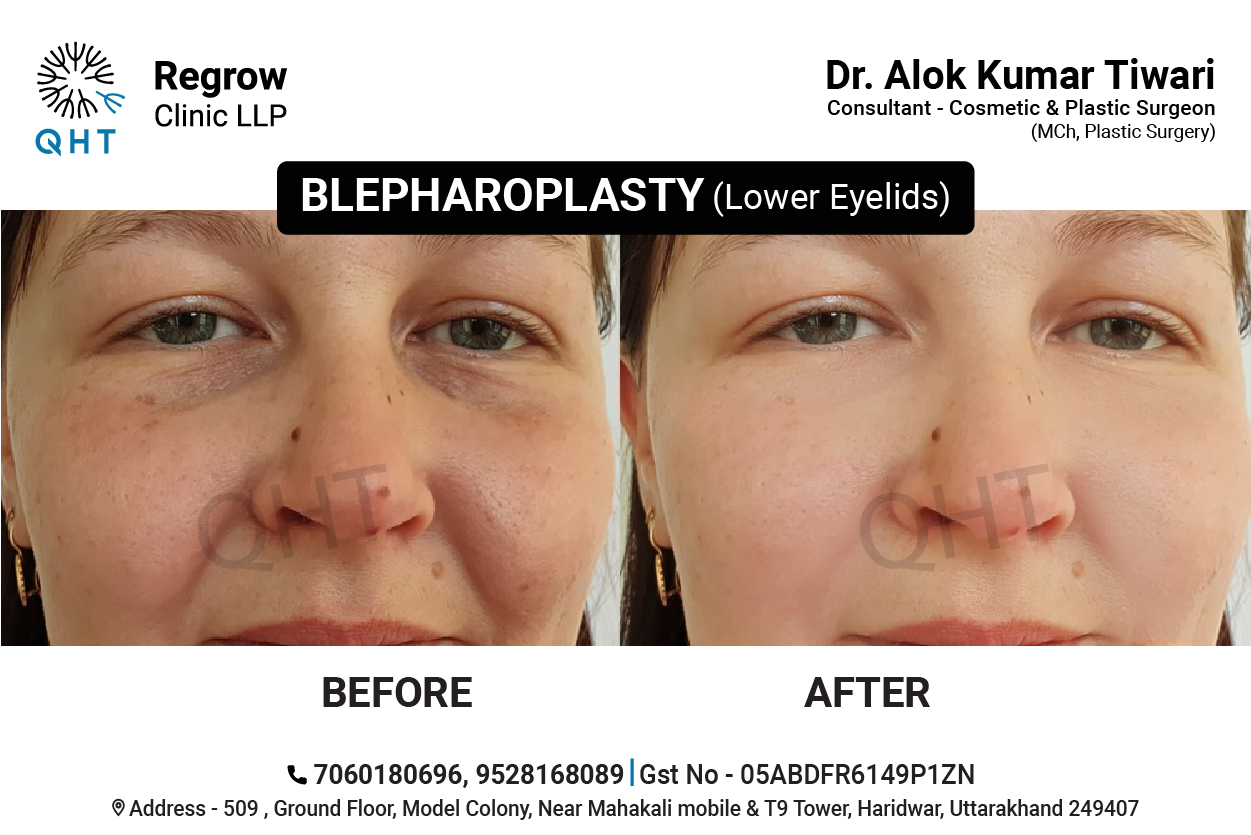 blepharoplasty-qht