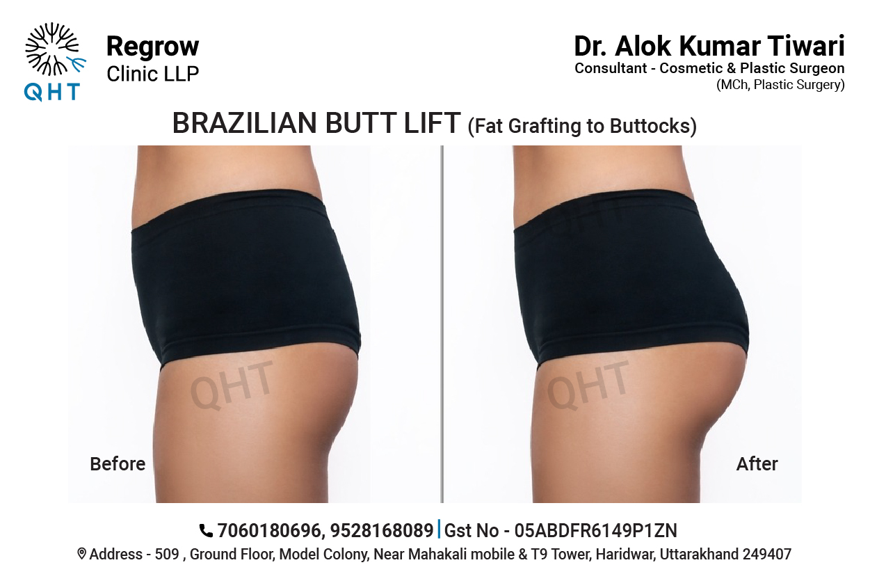 fat-transfer-to-buttocks-qht