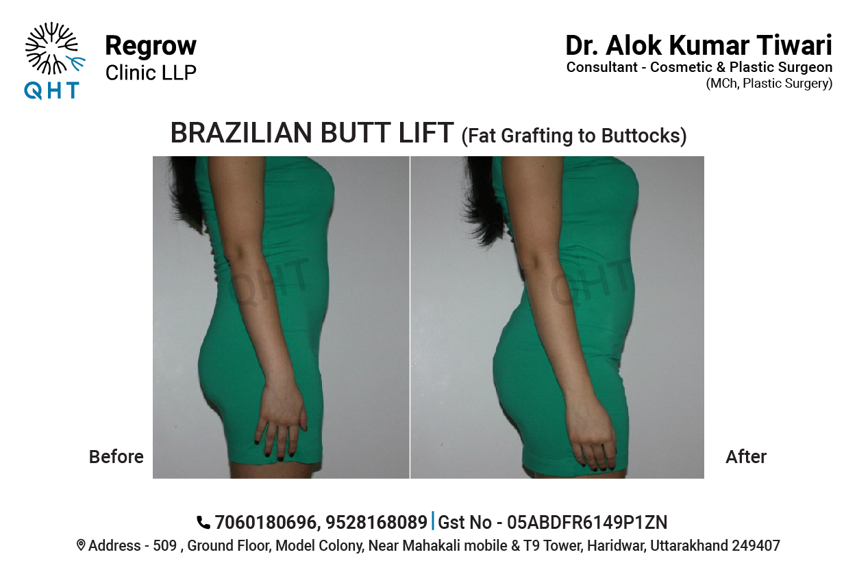 fat-transfer-to-buttocks-qht