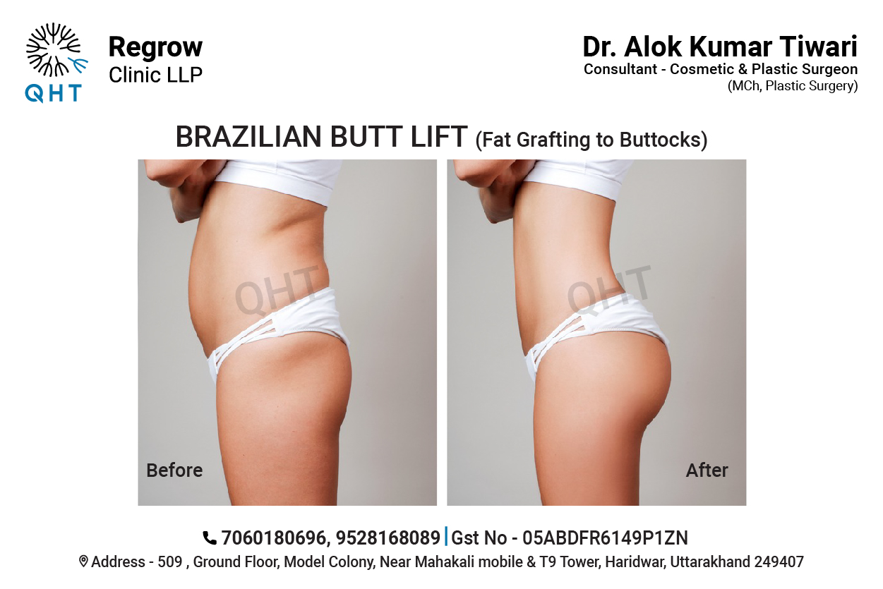 fat-transfer-to-buttocks-qht