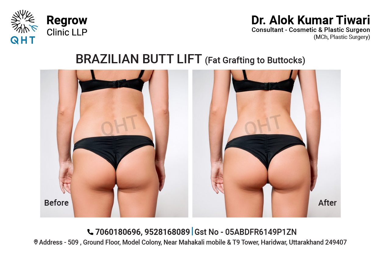 fat-transfer-to-buttocks-qht