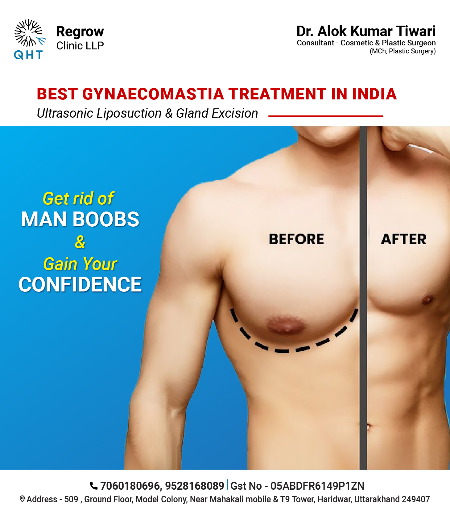 GYNAECOMASTIA-QHT