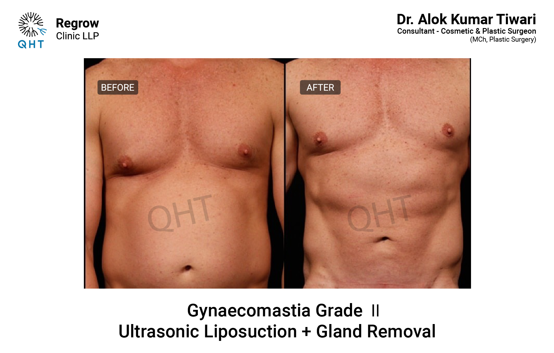 GYNAECOMASTIA-QHT