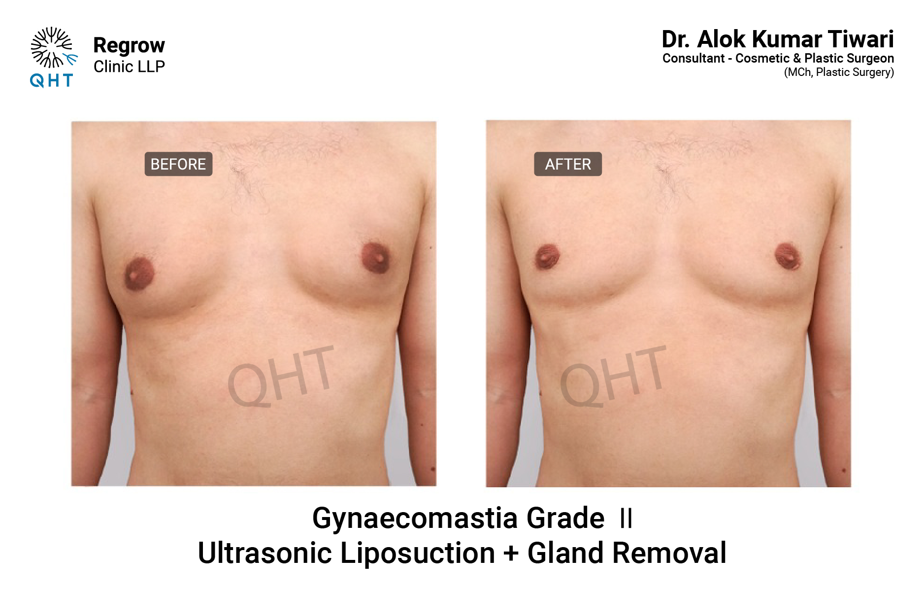 Gynecomastia-qht