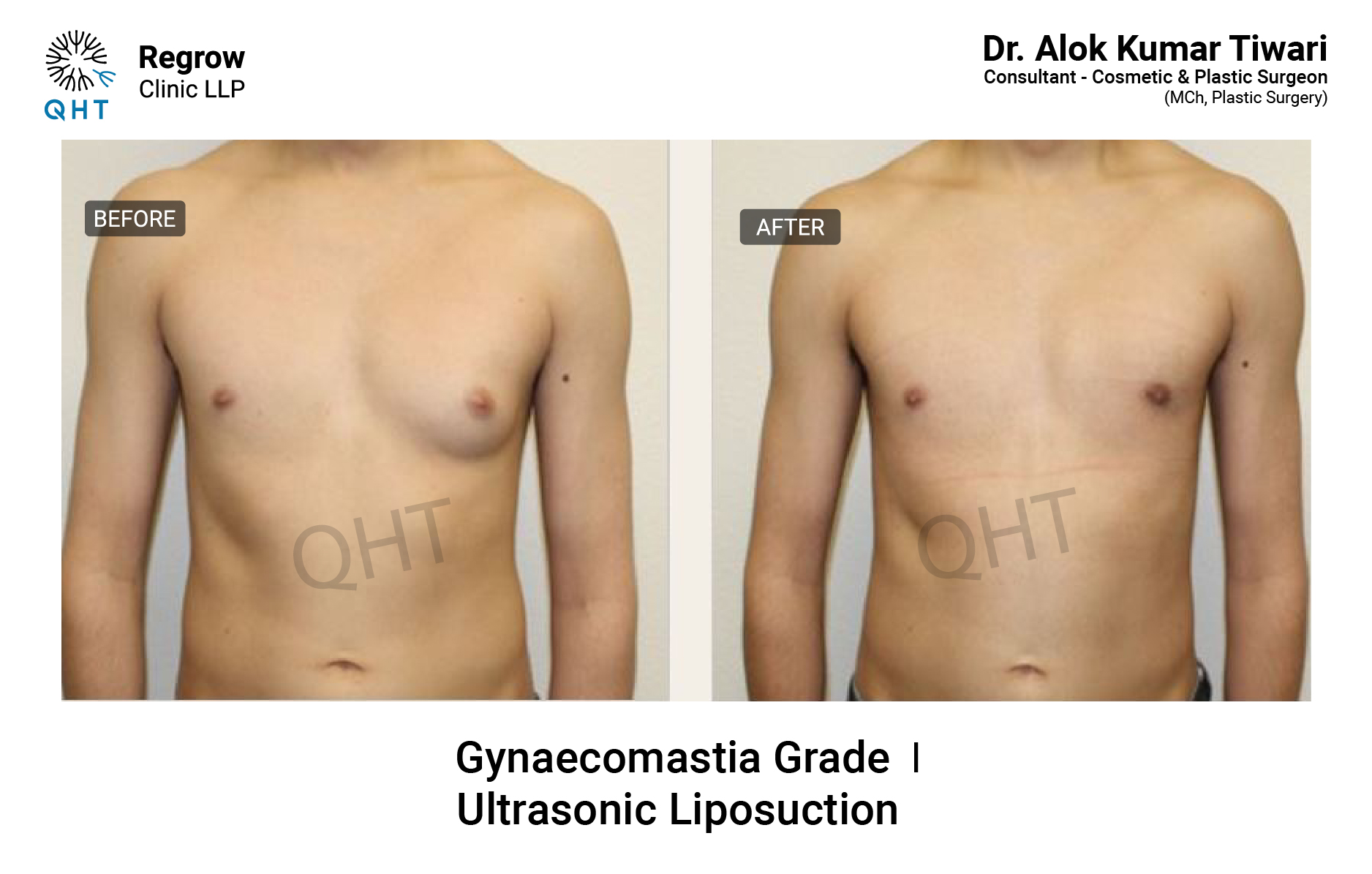 Gynecomastia-qht