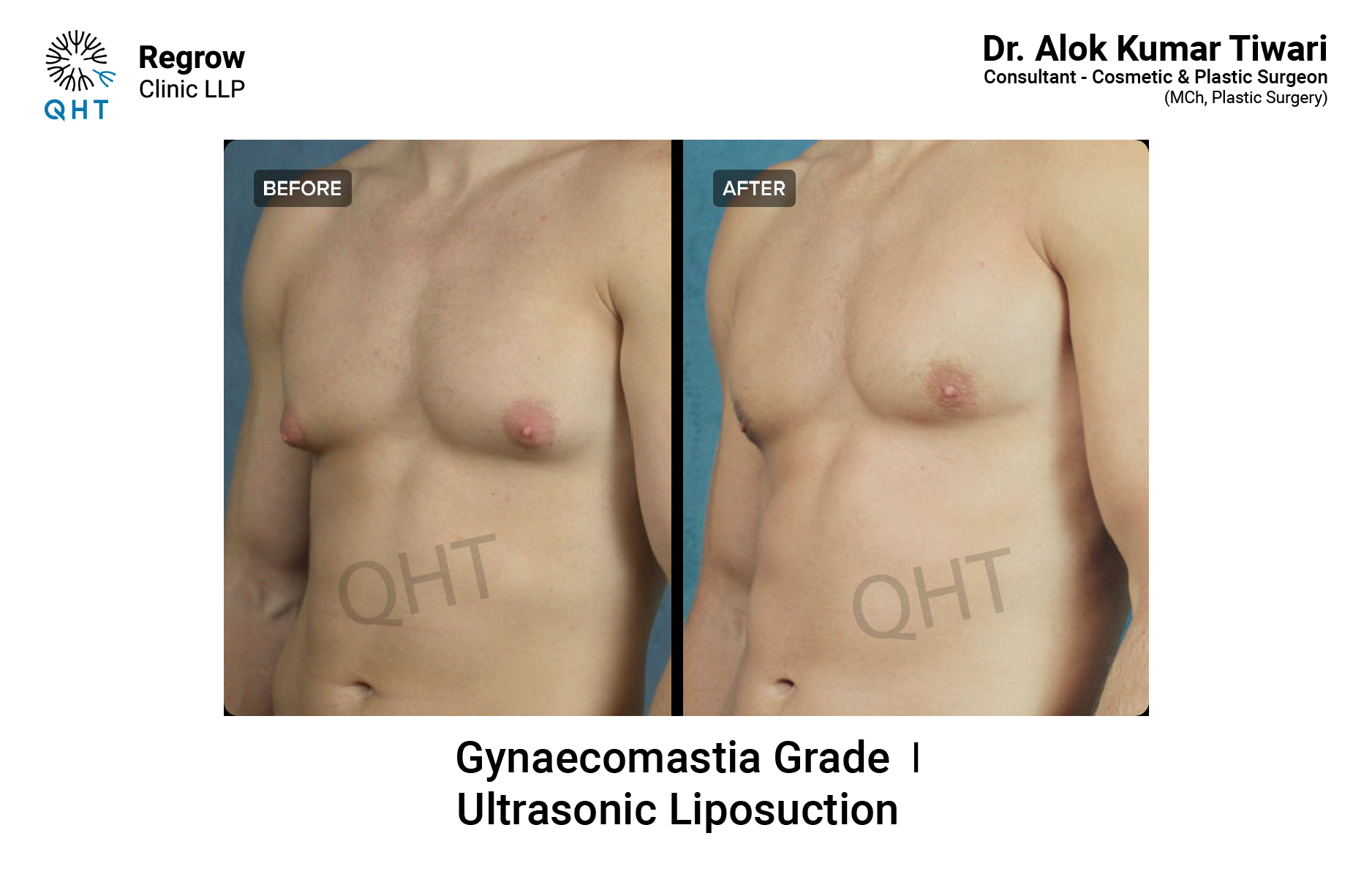 Gynecomastia-qht