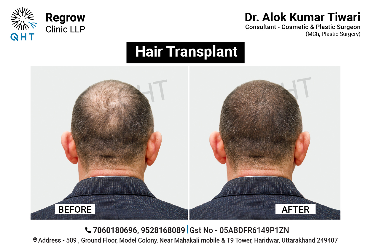 hair-transplant-qht