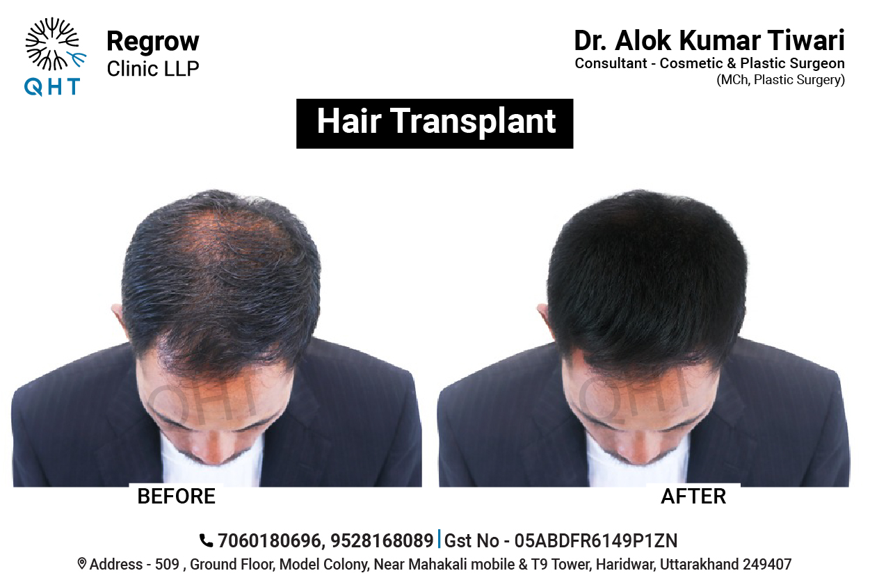 hair-transplant-qht