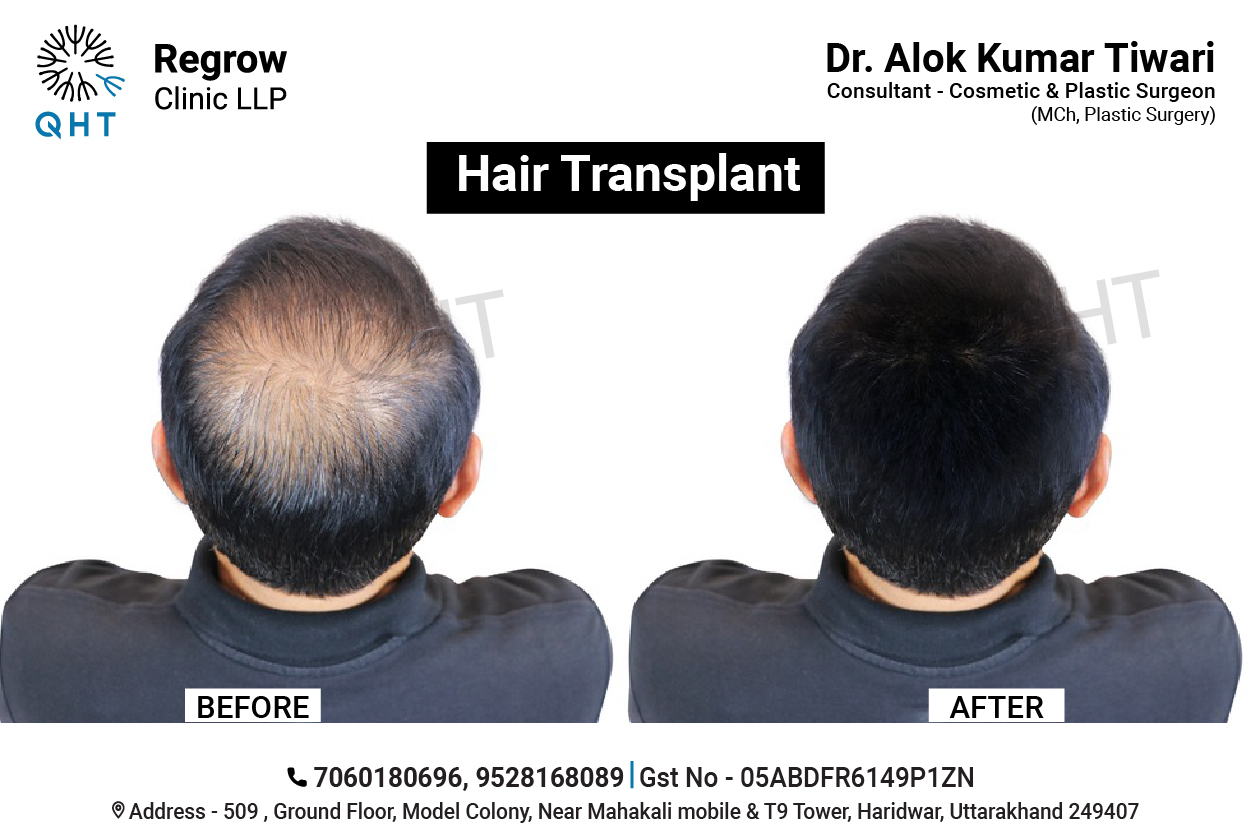 hair-transplant-qht