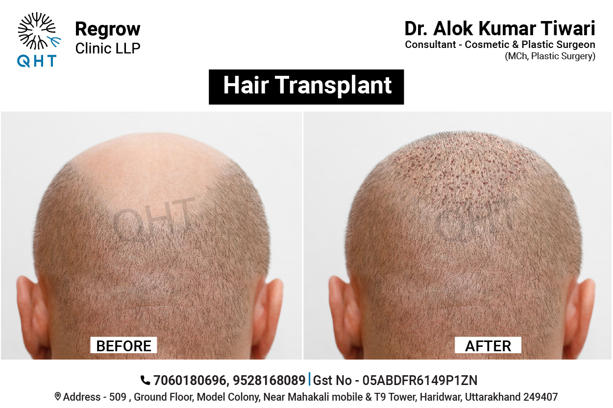 hair-transplant-qht