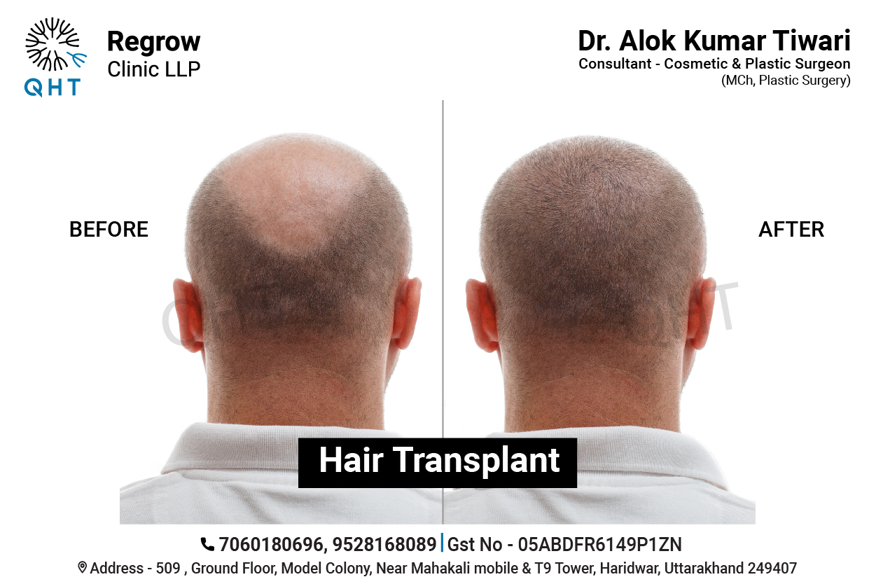 hair-transplant-qht