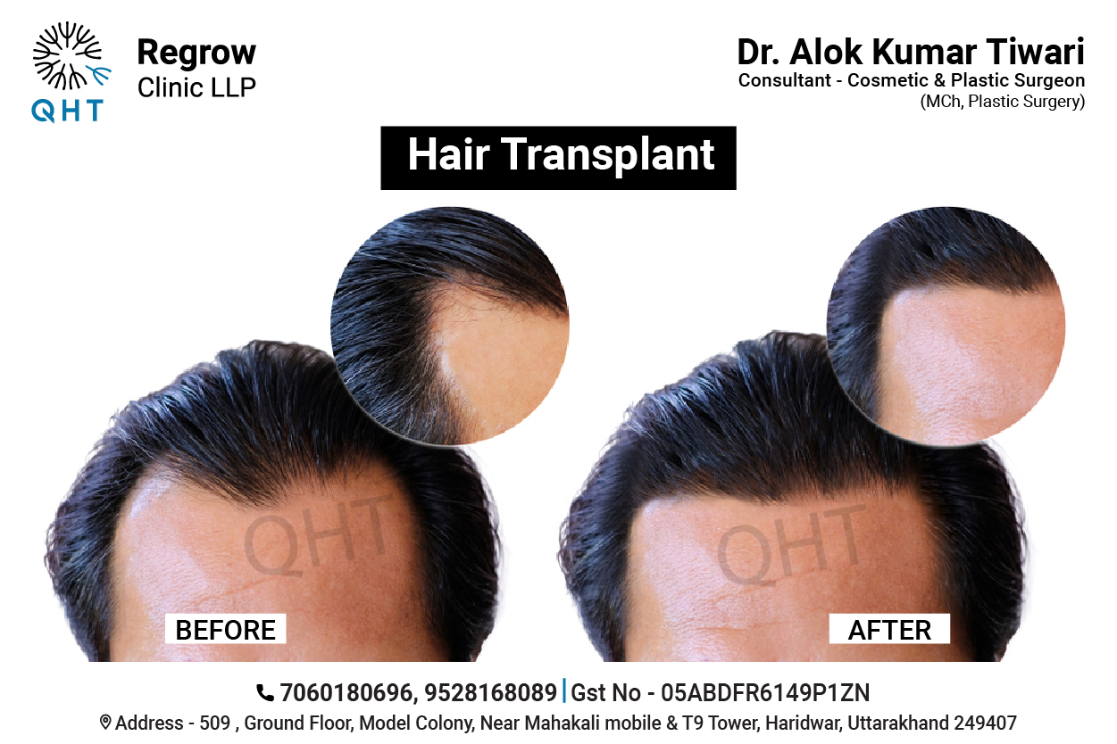 hair-transplant-qht