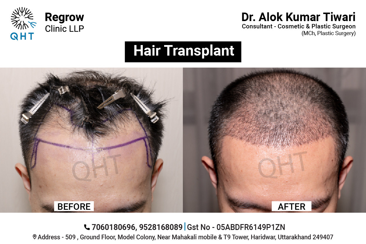 hair-transplant-qht