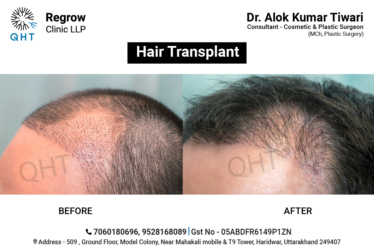 hair-transplant-qht