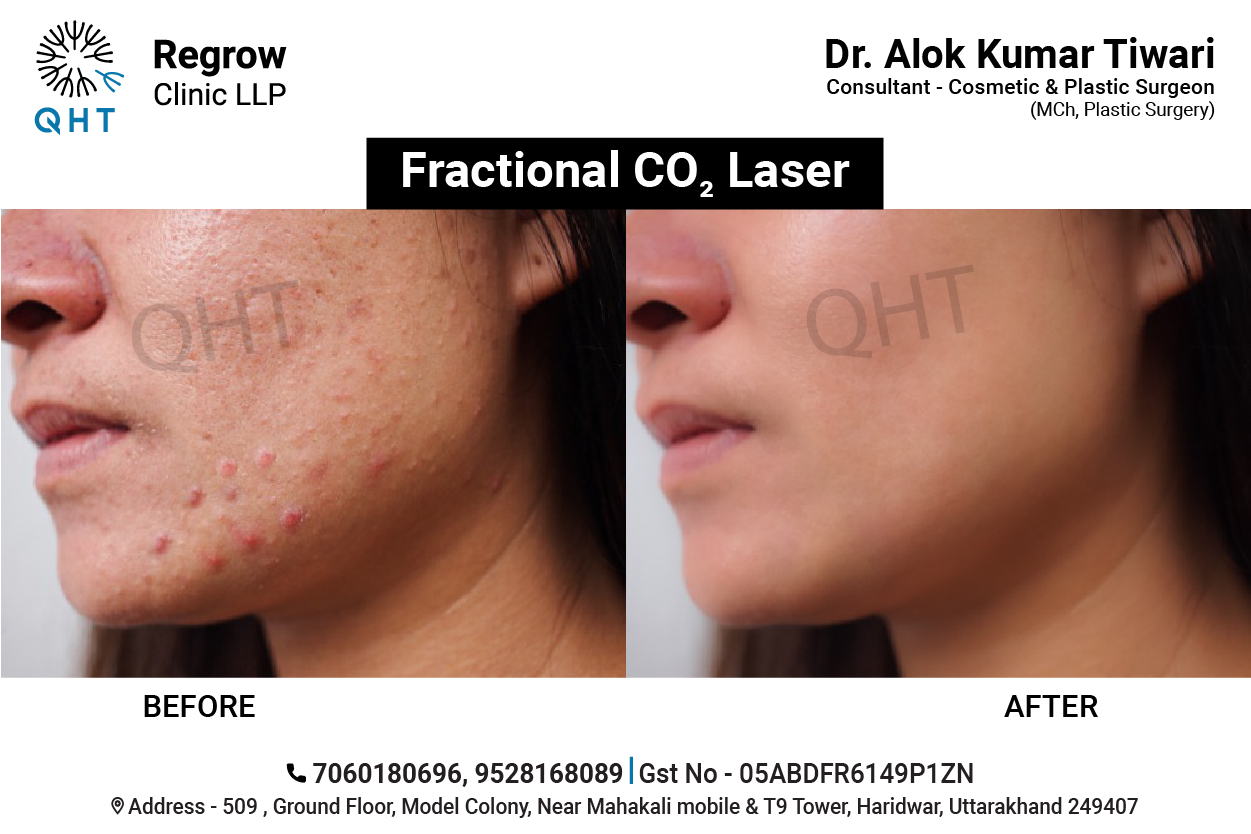 laser-scar-removal-qht