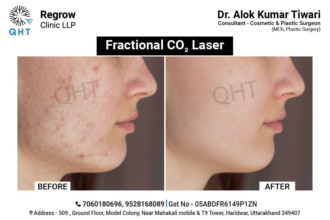 laser-scar-removal-qht