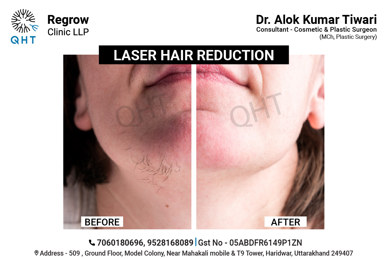 laser-hair-removal-qht