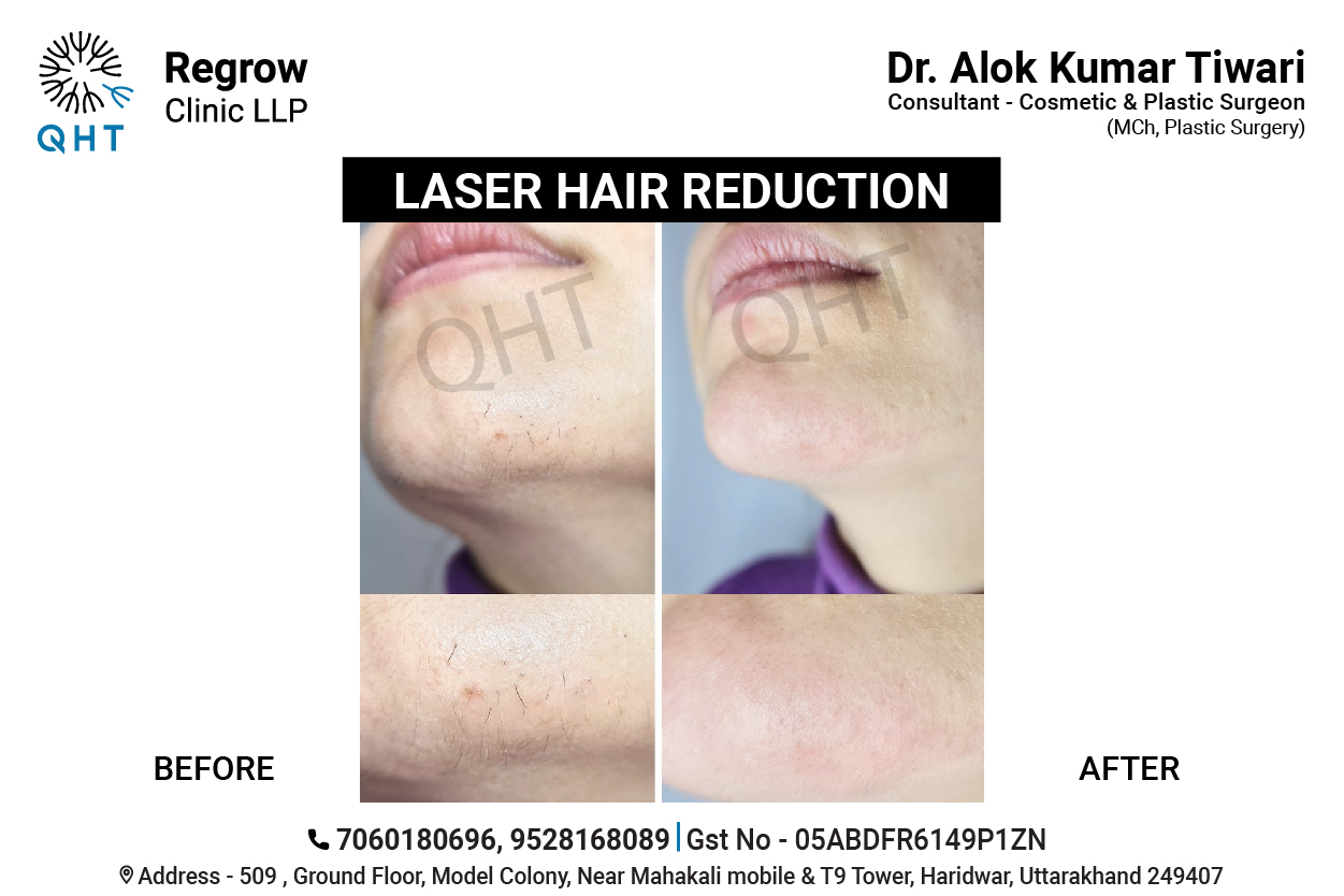 laser-hair-removal-qht