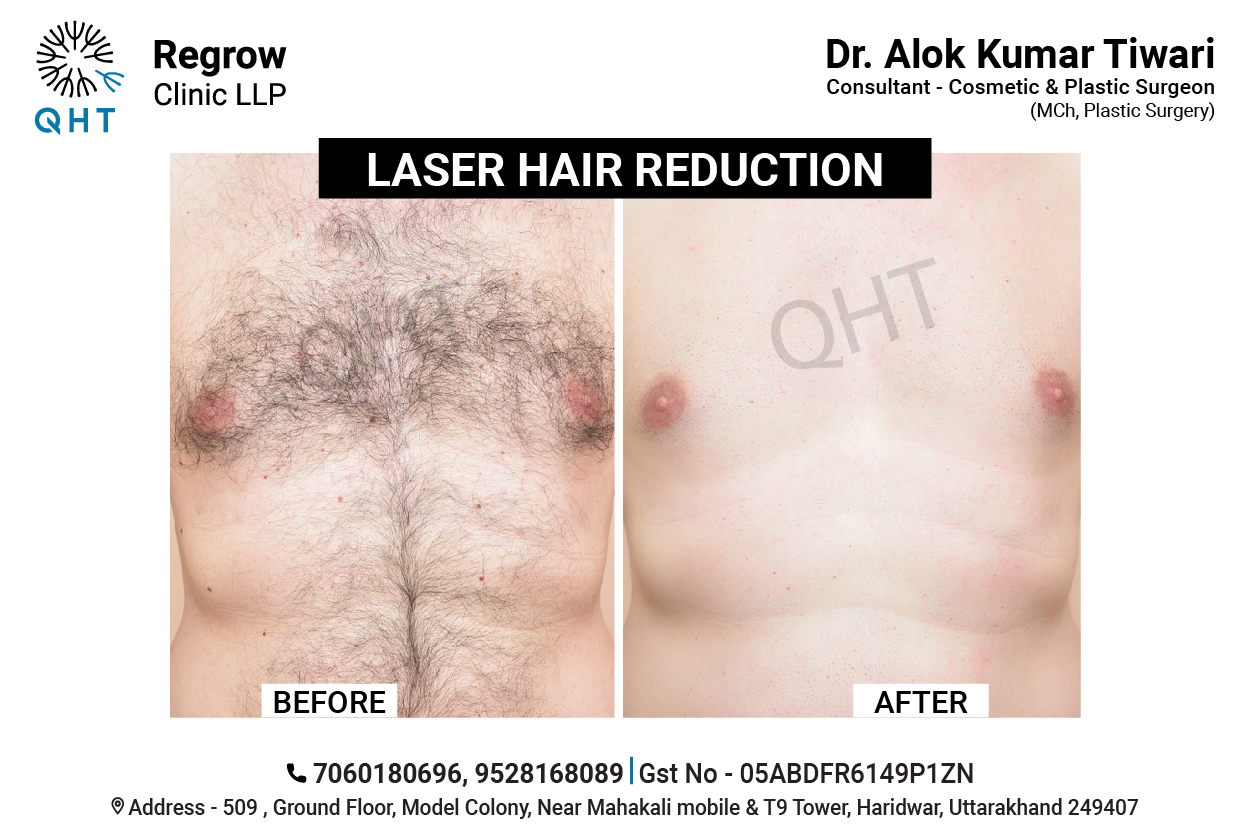 laser-hair-removal-qht