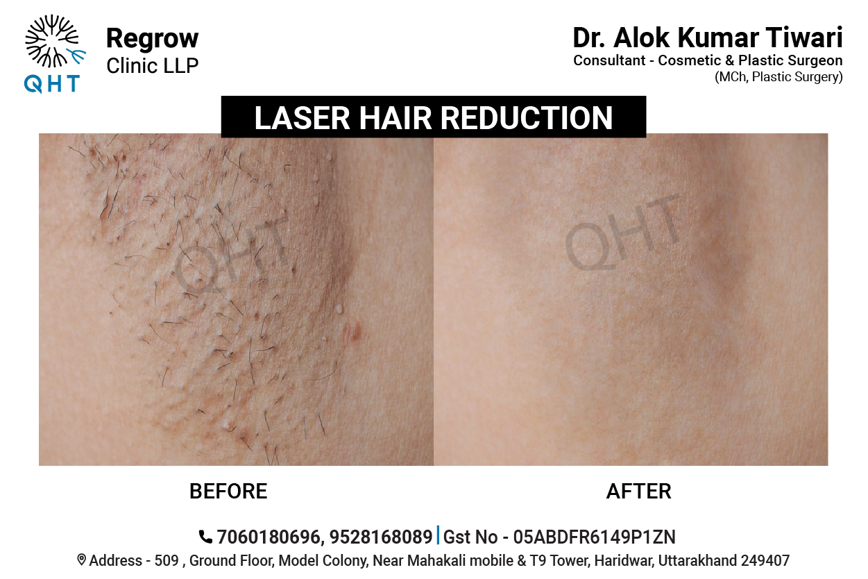 laser-hair-removal-qht