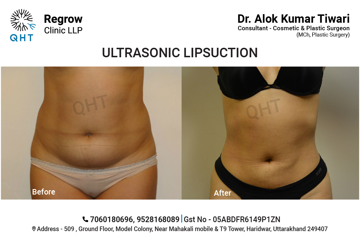 Liposuction-Female-QHT