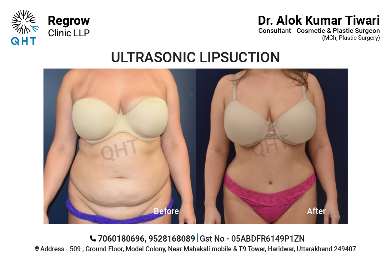 Liposuction-Female-QHT