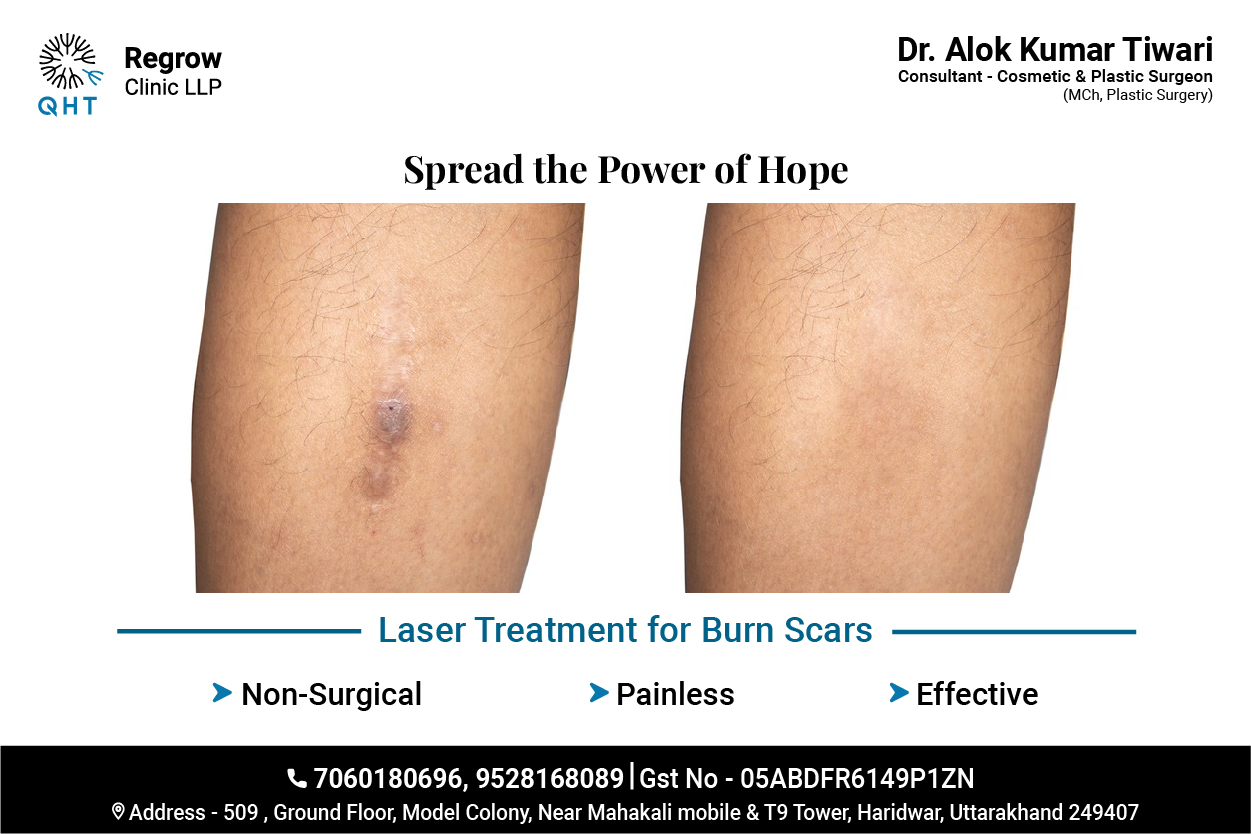 laser-for-burn-scar-qht